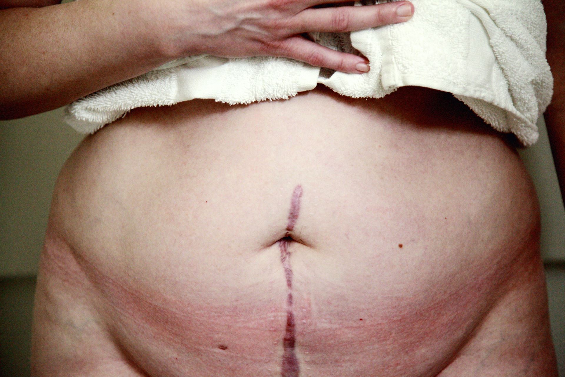 Abdomen